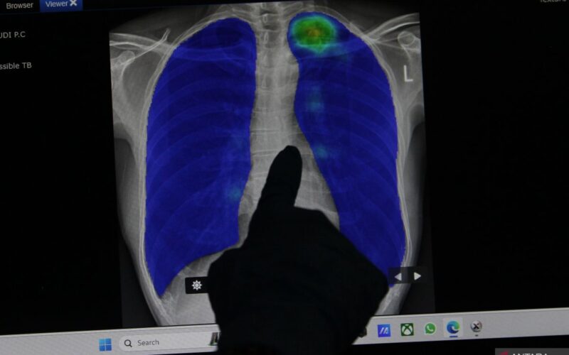 Dokter meluruskan mitos seputar paru-paru basah